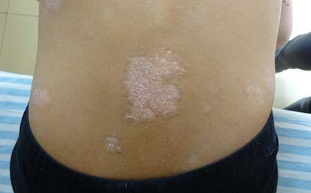 濰坊牛皮癬治療方法冬季牛皮癬加重原因