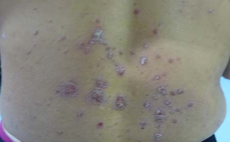 濰坊有哪些治銀屑病醫(yī)院銀屑病好轉(zhuǎn)征兆