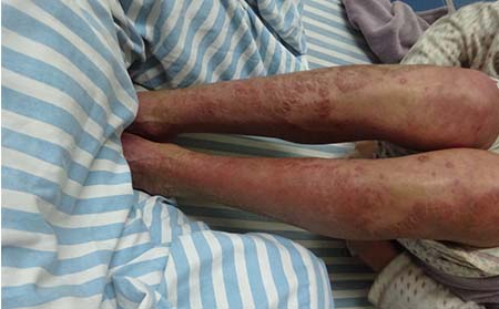 濰坊看牛皮癬醫院哪里好牛皮癬飲食注意