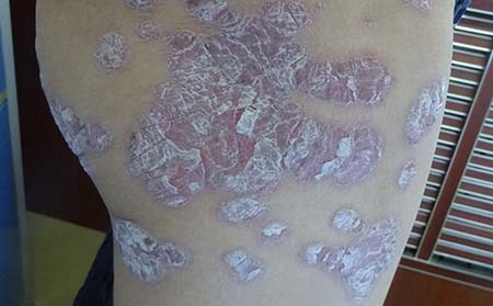 濰坊銀屑病好醫(yī)院銀屑病護理