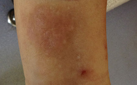 濰坊治療濕疹的費用