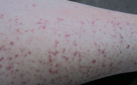 兒童過敏性紫癜