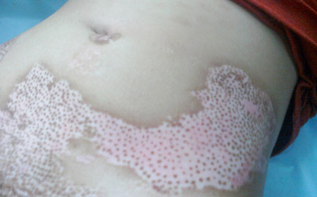 得了白癜風怎么辦,剛患上白癜風怎么辦