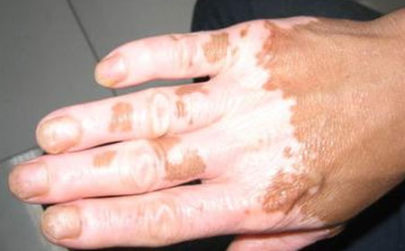 手部白癜風(fēng)癥狀,手部白癜風(fēng)什么樣
