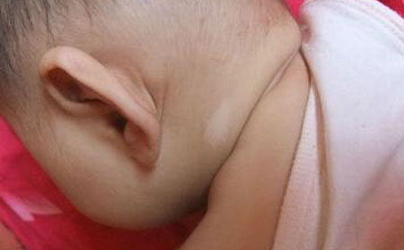 兒童白癜風常識,白癜風長在什么部位