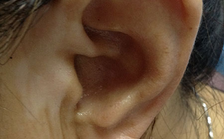 阻礙白癜風痊愈的原因有哪些