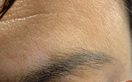 嘴角有白癜風(fēng)該注意哪些問題