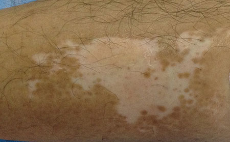 治療兒童白癜風需要注意哪些