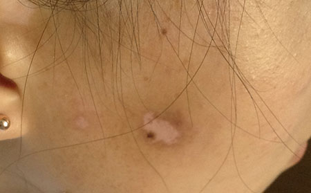 治療白癜風(fēng)應(yīng)采取什么措施