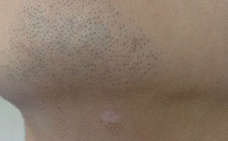 治療白癜風有哪些常見誤區