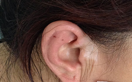 治療白癜風飲食禁忌有哪些