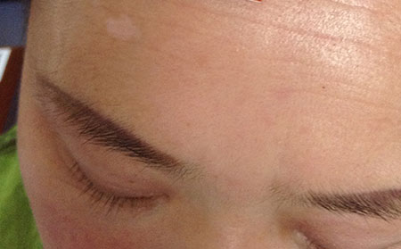 治療白癜風要注意什么