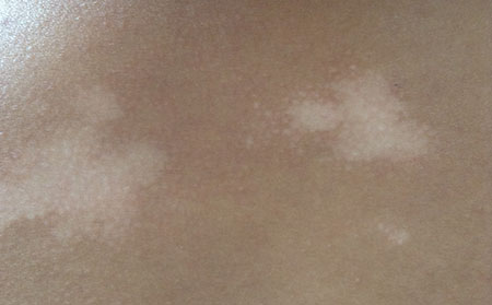 治療白癜風要怎么選擇好的醫院