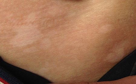 治療白癜風要從多方面努力