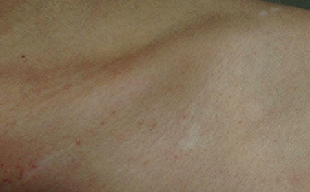 治療白癜風需要多長時間