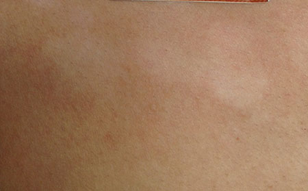 治療白癜風需要多長的時間