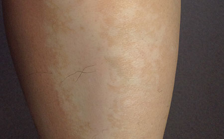 治療白癜風生活上需要注意什么