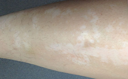 治療白癜風患兒應繞開的誤區