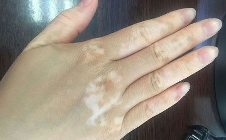 治療白癜風,治療白癜風好方法,中醫治療白癜風