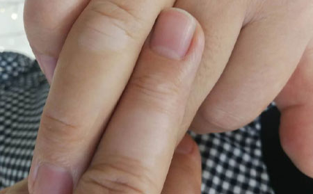 治療白癜風,白癜風的常見誤區