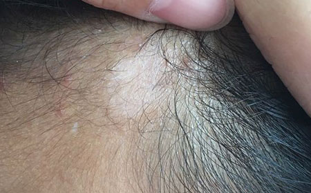 診斷白癜風的兩大要點