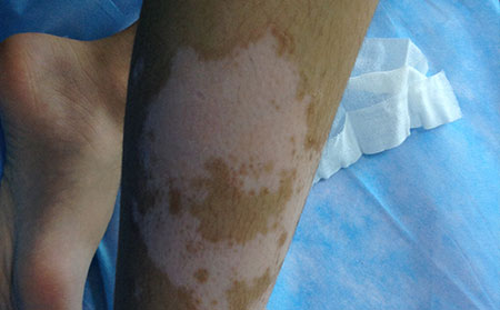 治療白癜風的誤區