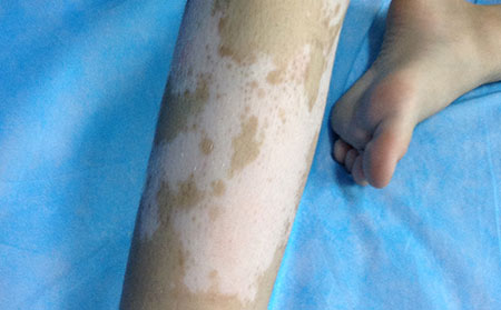 白癜風不能吃,白癜風飲食禁忌,白癜風能吃什么