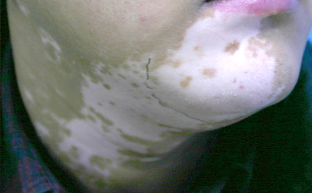 治療白癜風,白癜風治療方法,白癜風常識