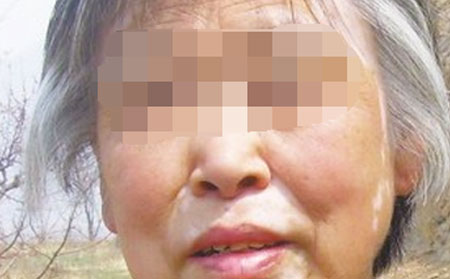 預(yù)防白癜風(fēng),預(yù)防白癜風(fēng)方法