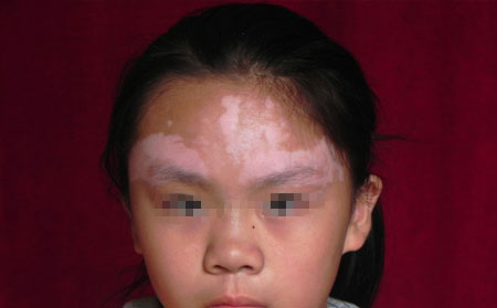 白癜風(fēng)傳染嗎,白癜風(fēng)會不會傳染,白癜風(fēng)傳染么