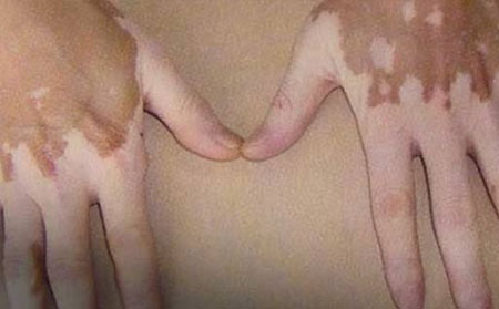 白癜風病因,白癜風的病因,濰坊銀康皮膚病醫院