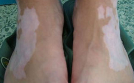 預(yù)防白癜風(fēng),白癜風(fēng)復(fù)發(fā),預(yù)防白癜風(fēng)復(fù)發(fā),白癜風(fēng)常識