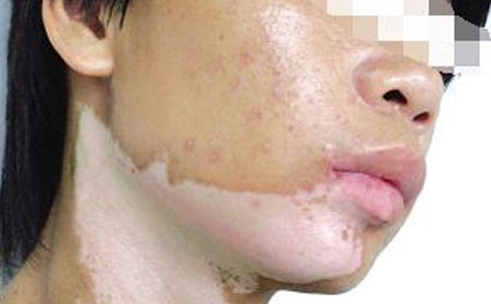 鑒別白癜風,如何區分白癜風,白癜風癥狀表現,白癜風圖片