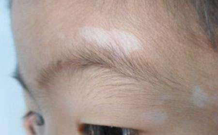 白癜風飲食,白癜風飲食禁忌,白癜風飲食吃什么好