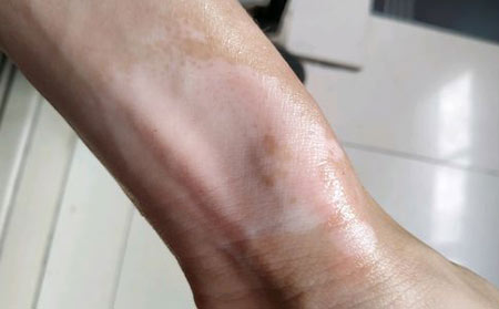 局限性白癜風,白癜風復發,白癜風預防