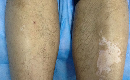 預防白癜風,兒童白癜風,預防兒童白癜風