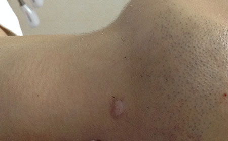 判斷白癜風,兒童白癜風,白癜風病因