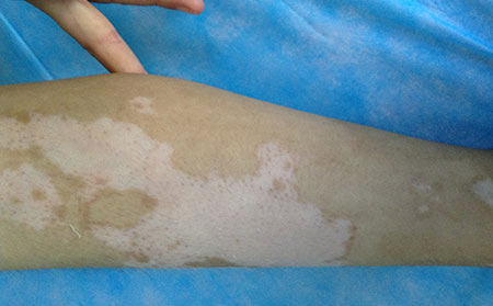 早期白癜風,白癜風外用藥,白癜風能治好嗎,治療白癜風醫院