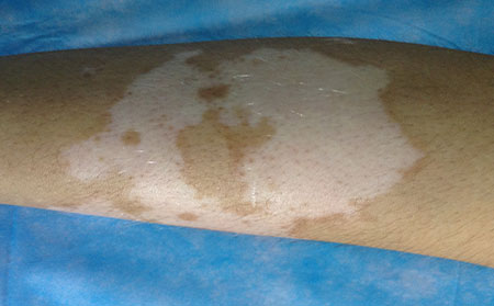 早期白癜風,白癜風癥狀表現,早期白癜風癥狀