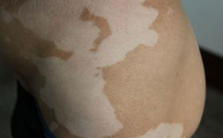 治療白癜風,治療白癜風多少錢,治療白癜風醫院