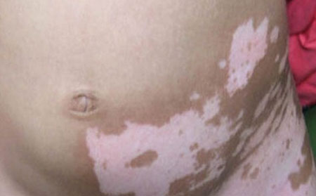 預防白癜風,怎么預防白癜風,白癜風預防方法