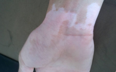 女性白癜風,孕婦白癜風,白癜風危害有哪些