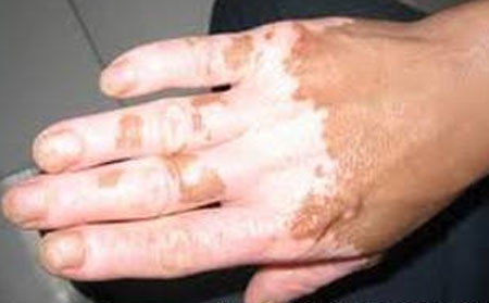 濰坊白癜風(fēng)醫(yī)院