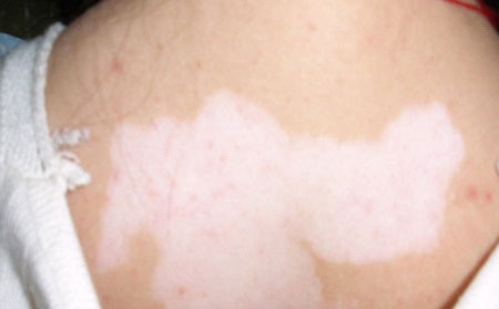 預(yù)防白癜風(fēng),濰坊白癜風(fēng)醫(yī)院,白癜風(fēng)怎么預(yù)防