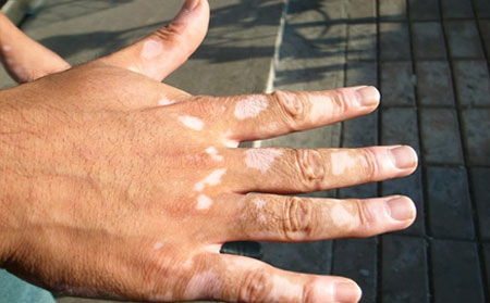 預(yù)防白癜風,預(yù)防白癜風發(fā)作,濰坊白癜風醫(yī)院