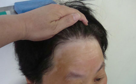 預(yù)防白癜風(fēng),白癜風(fēng)預(yù)防要點,濰坊白癜風(fēng)醫(yī)院