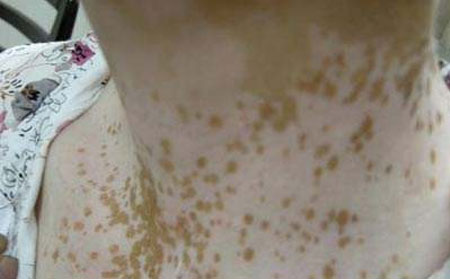 白癜風發病原因,白癜風病因,誘發白癜風病因