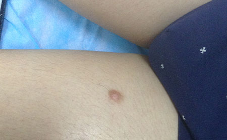 預(yù)防白癜風(fēng),預(yù)防白癜風(fēng)的方法