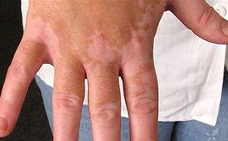 白癜風發病原因,白癜風病因,導致白癜風的外在原因