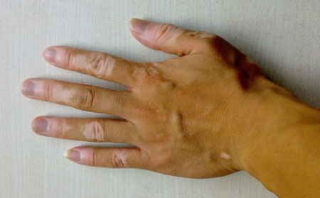 白癜風發病原因,白癜風病因,誘發白癜風